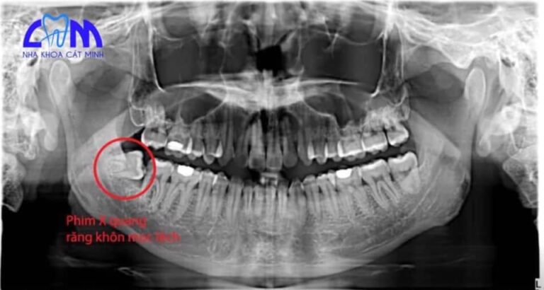 Có Nên Giữ Lại Răng Khôn Nếu Không Gây Đau? Những Điều Cần Biết Trước Khi Quyết Định