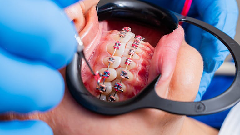 Close-up of dental braces being examined by dentist using tools with gloves.