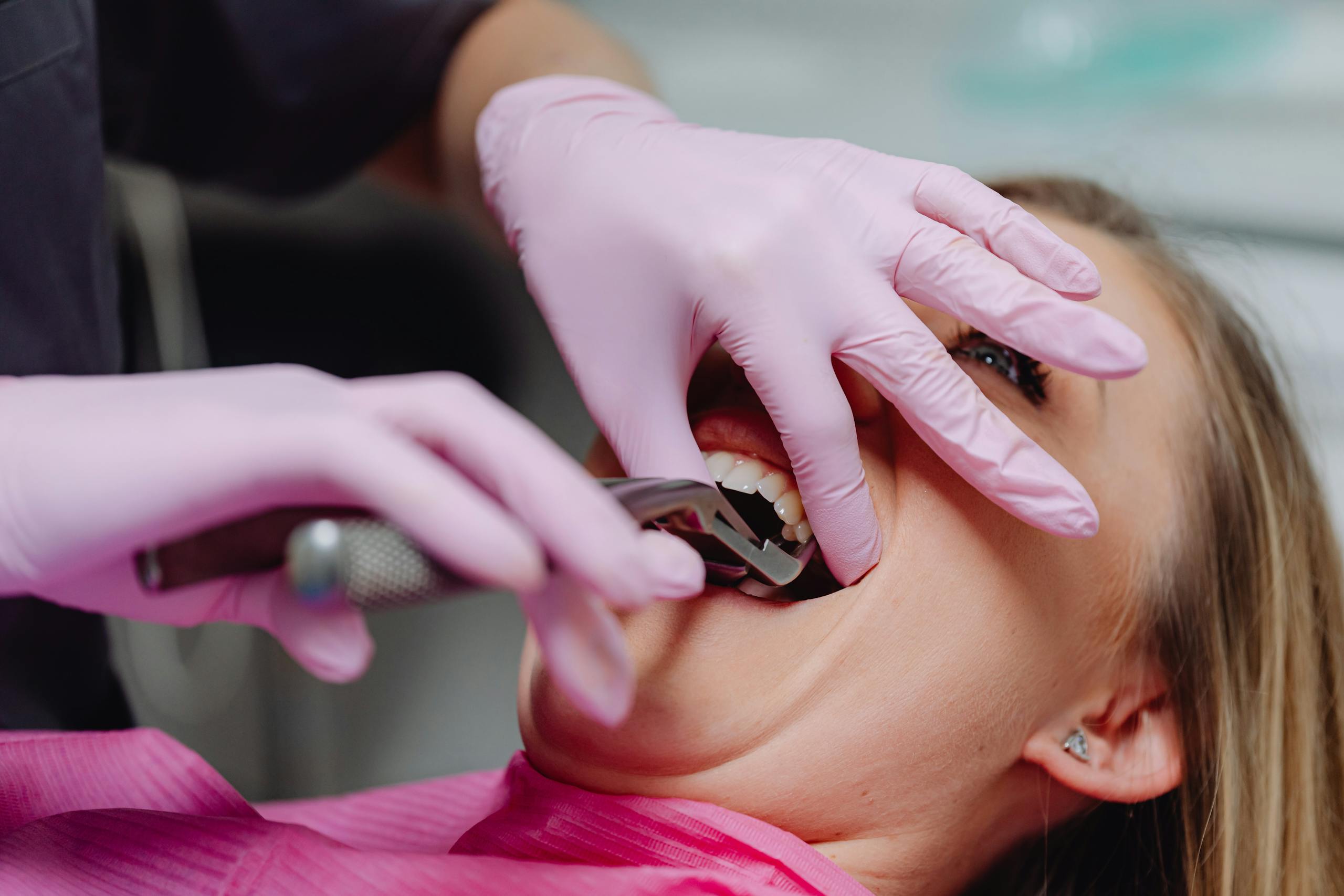 Dental professional using extracting forceps on a patient during a tooth extraction.